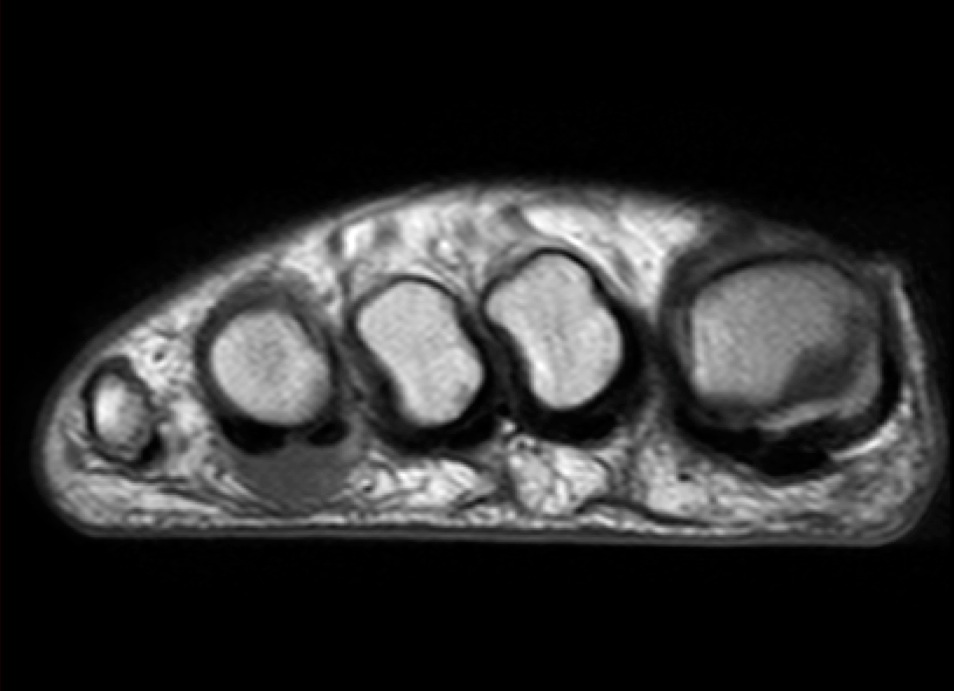 Figure 3 for case Advential bursitis